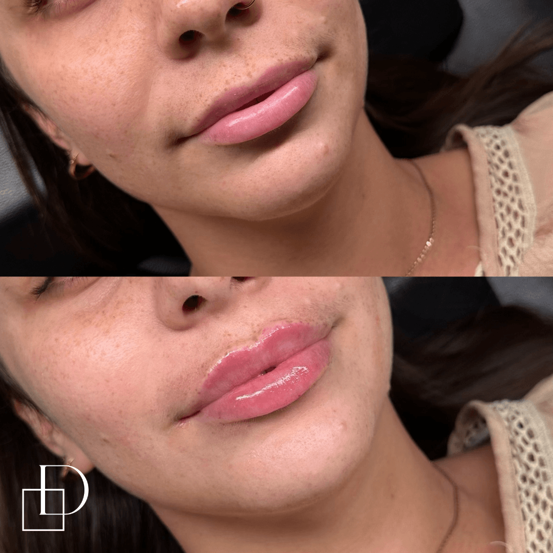 Before and after lip filler injections at Define Clinic Brisbane