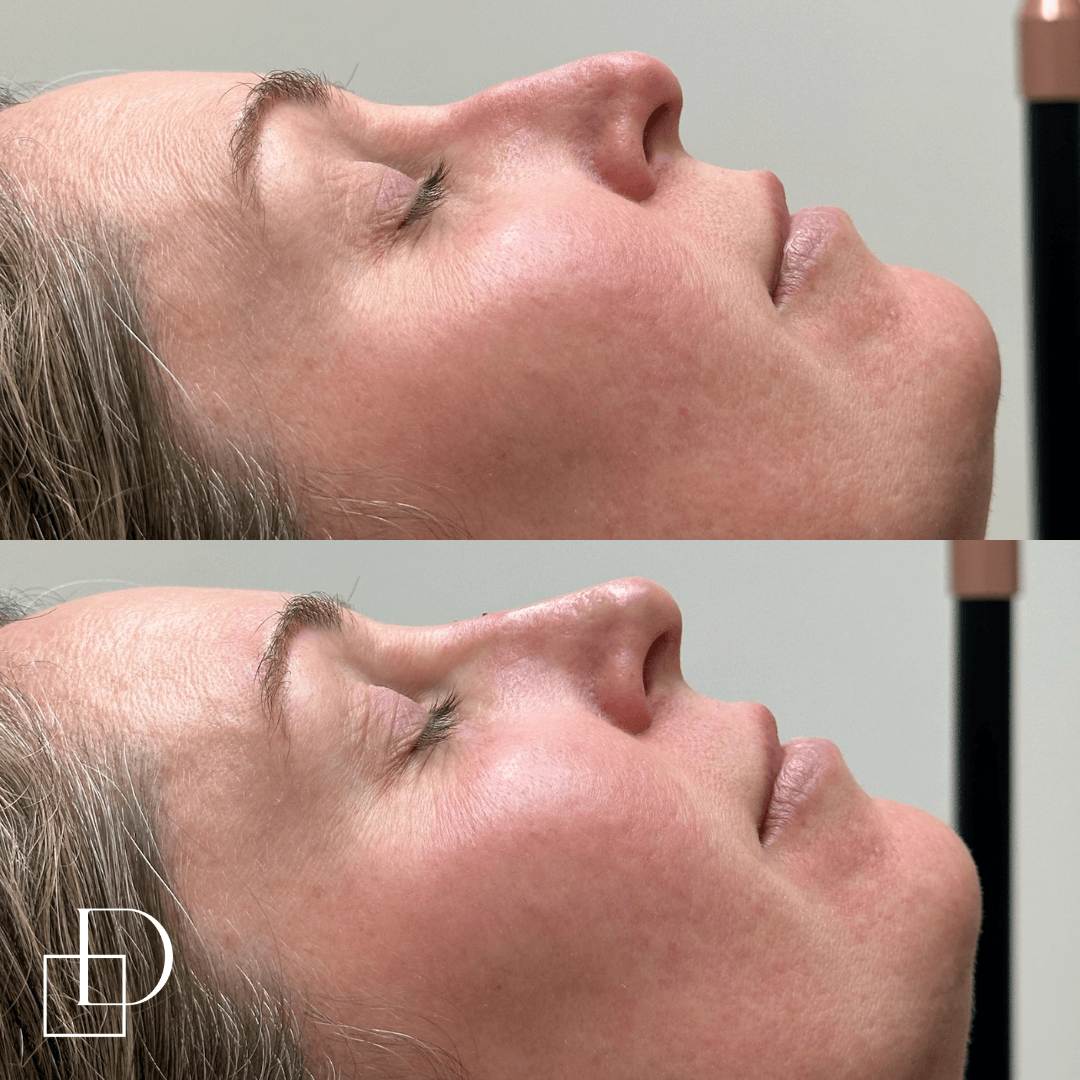 Before and after non-surgical rhinoplasty nose filler at Define Clinic Brisbane