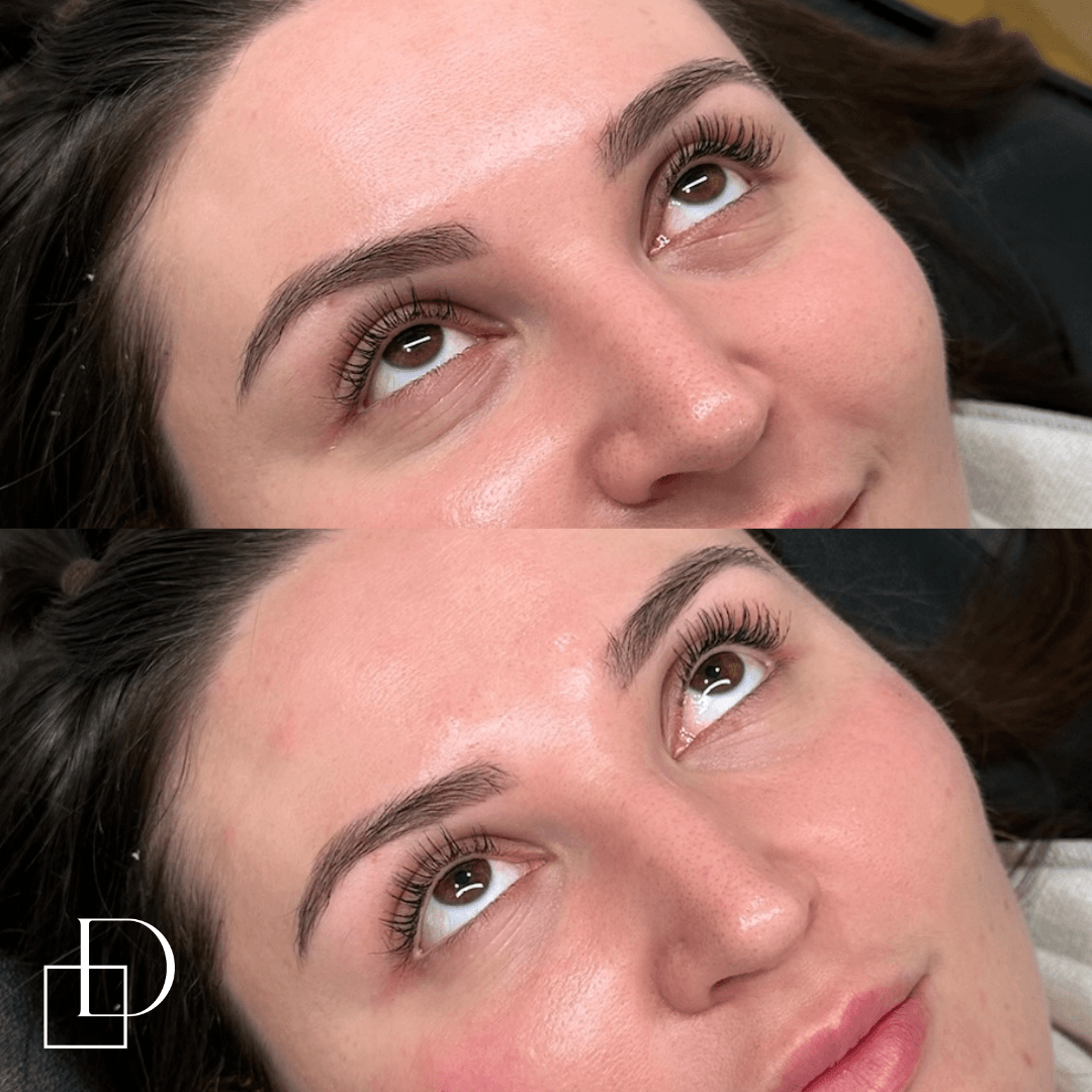 Before and after tear trough under eye filler injections at Define Clinic Brisbane
