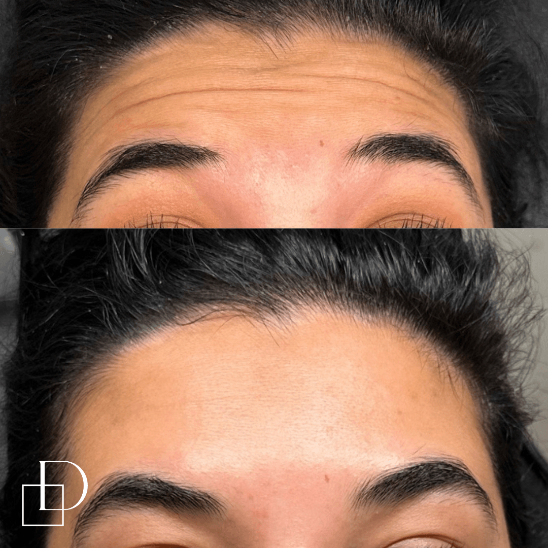 Before and after forehead botox anti-wrinkle at Define Clinic Brisbane