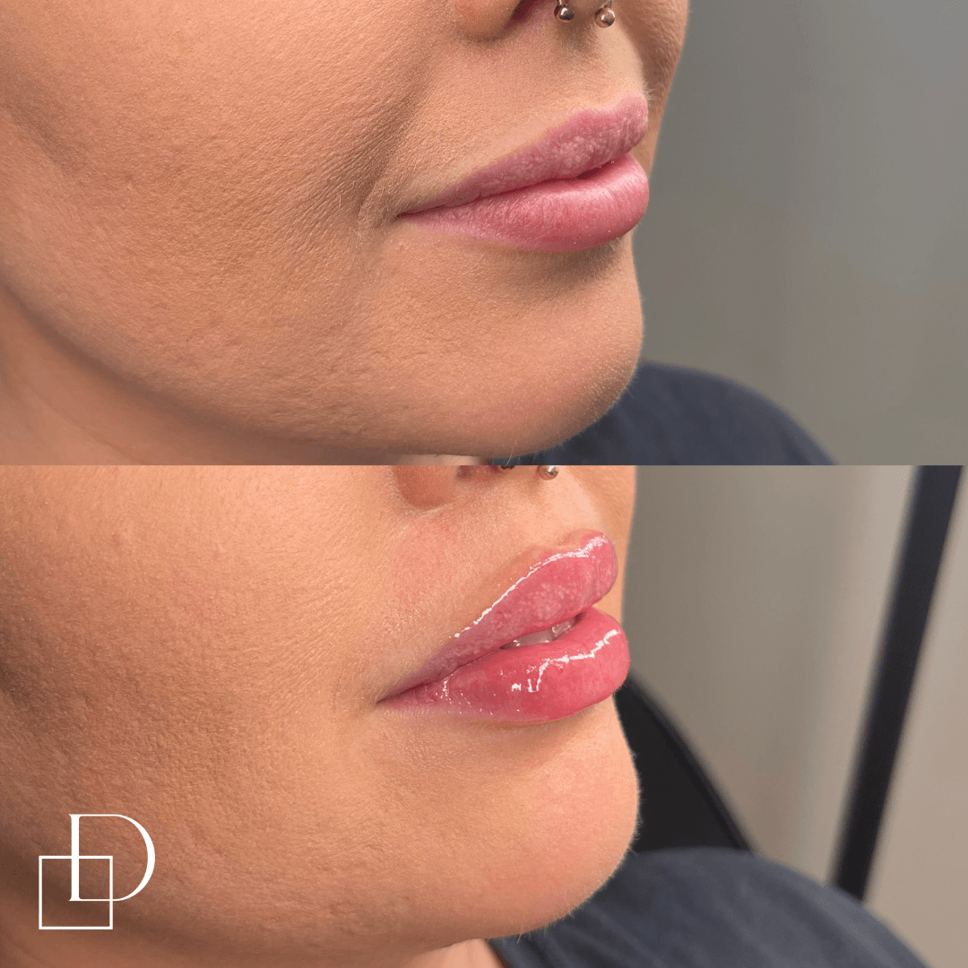 Before and after lip filler injections at Define Clinic Brisbane