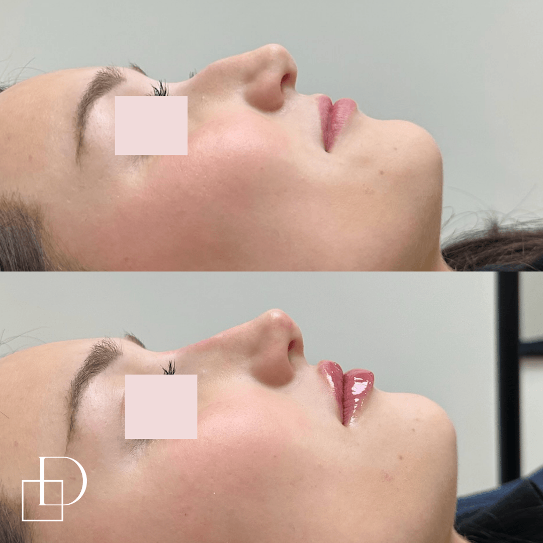 Before and after nose and lip filler injections at Define Clinic Brisbane