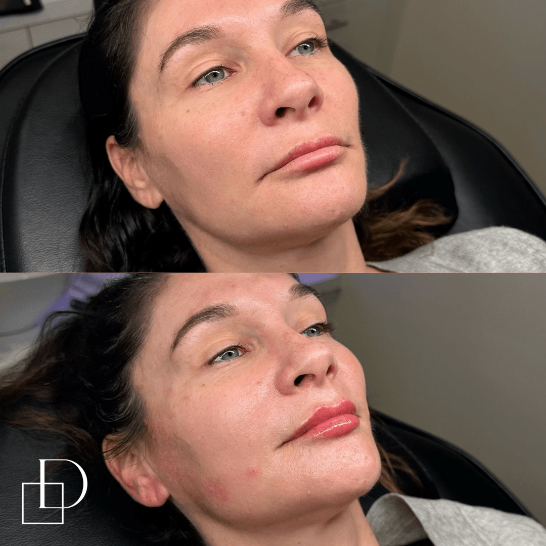 Before and after lip filler injections at Define Clinic Brisbane