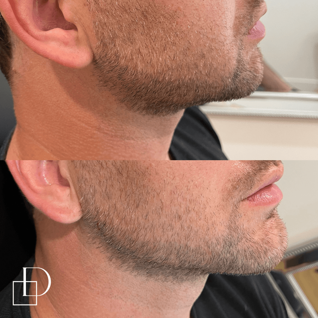 Before and after cosmetic dermal filler injections to male jawline at Define Clinic Brisbane