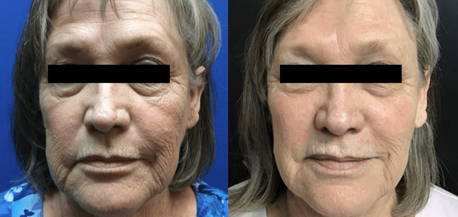 Before and after treatment with Laser Genesis at Define Clinic Brisbane
