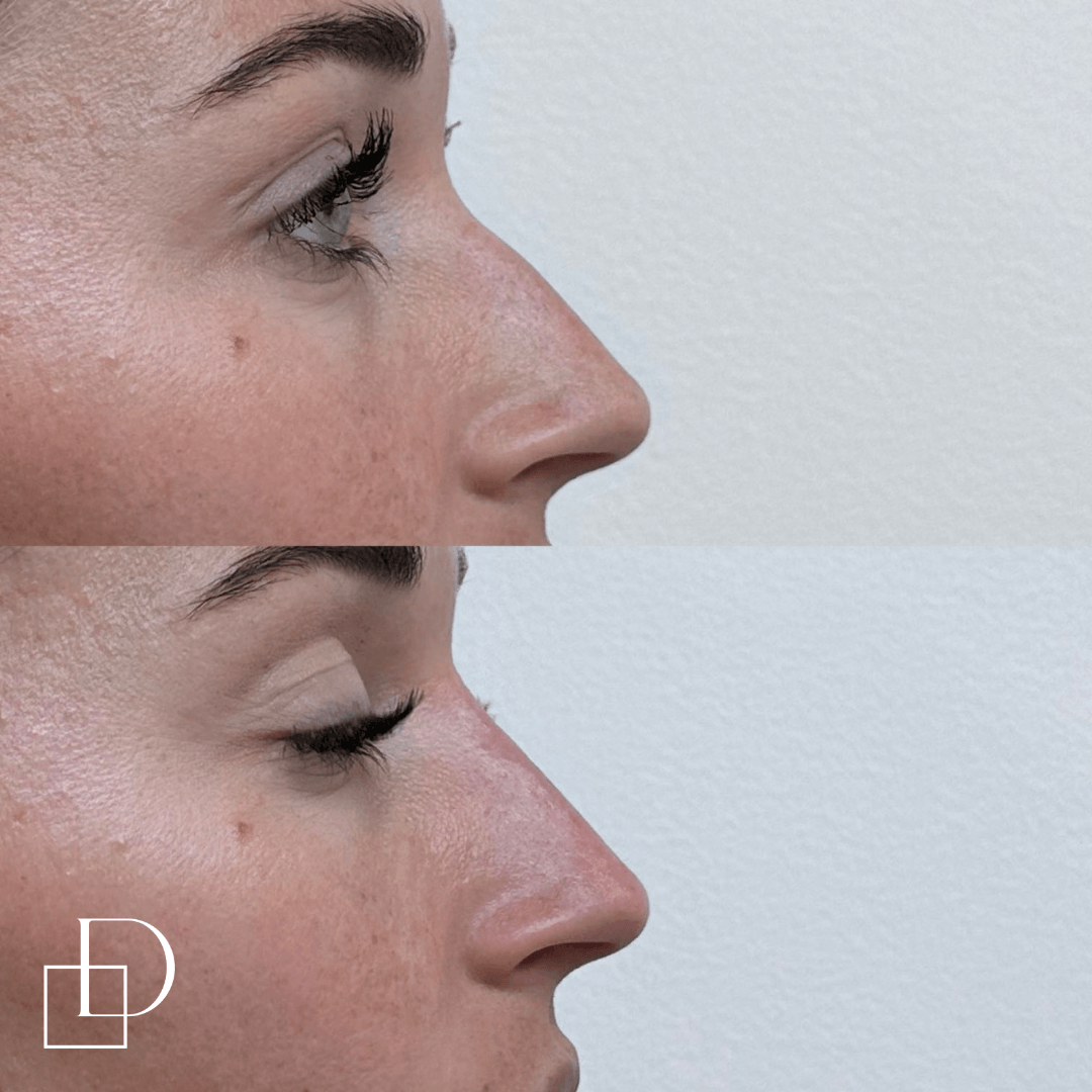 Before and after non-surgical rhinoplasty nose filler at Define Clinic Brisbane