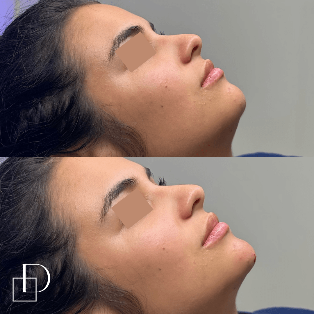 Before and after chin filler injections at Define Clinic Brisbane