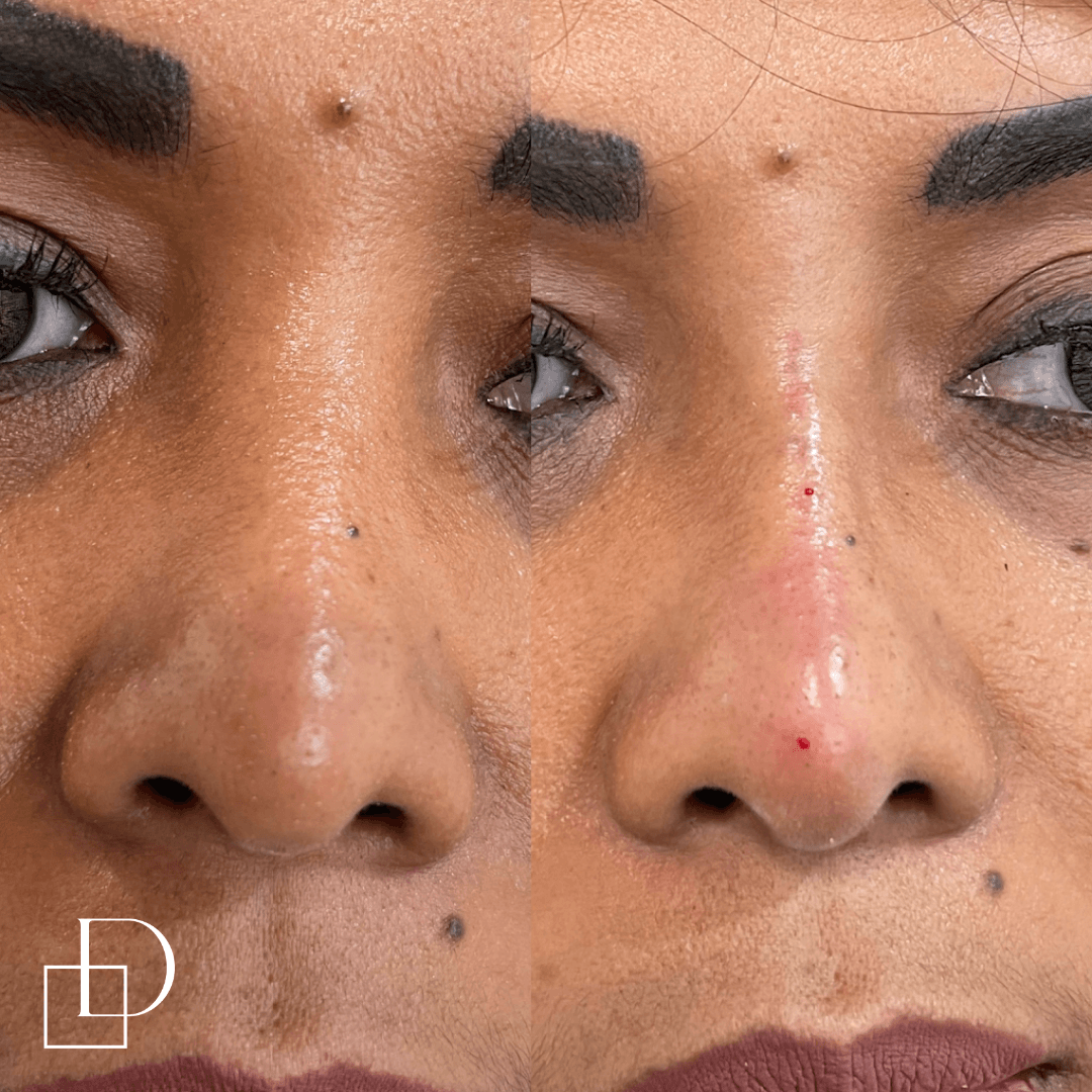 Before and after non-surgical rhinoplasty nose filler at Define Clinic Brisbane