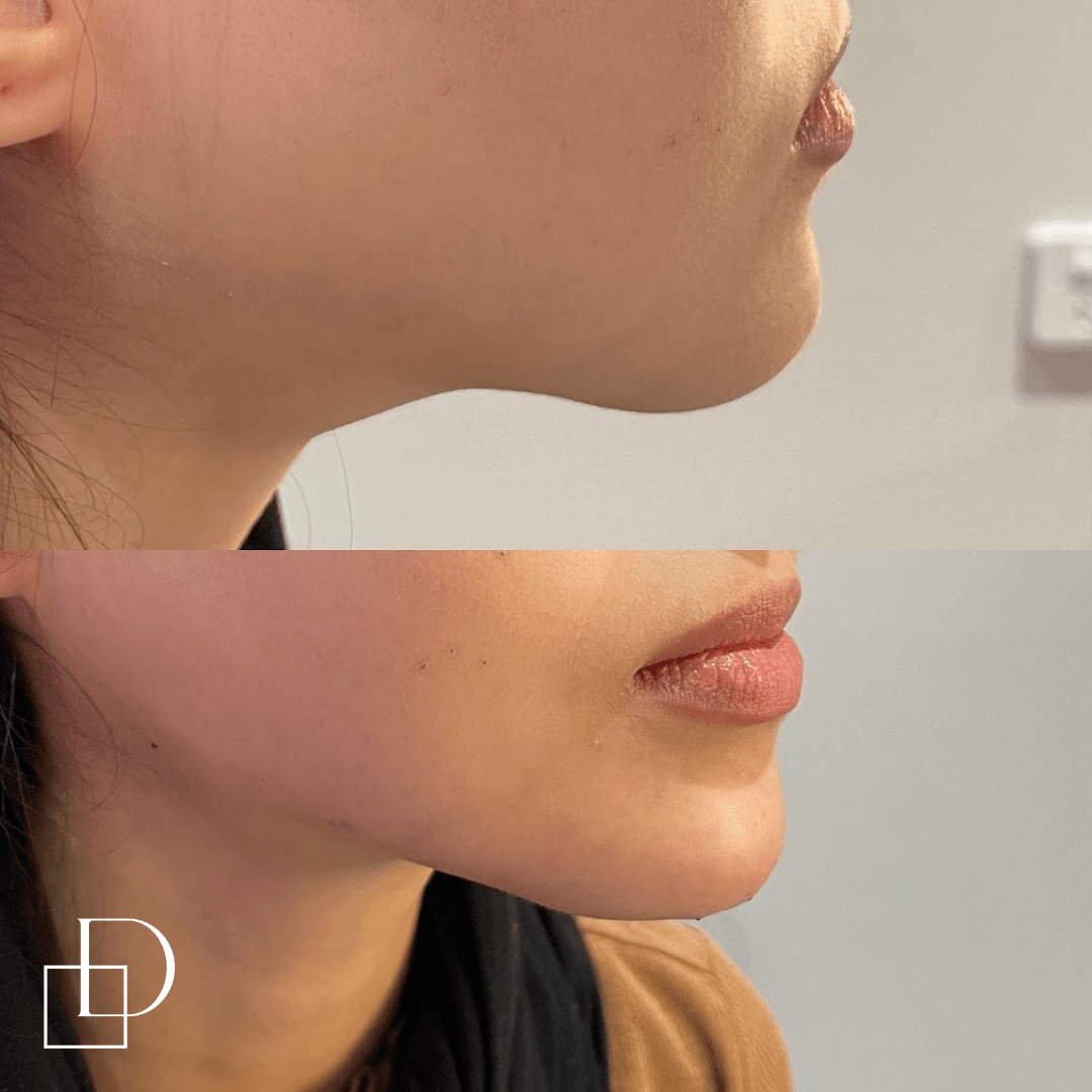 Before and after chin filler injections at Define Clinic Brisbane