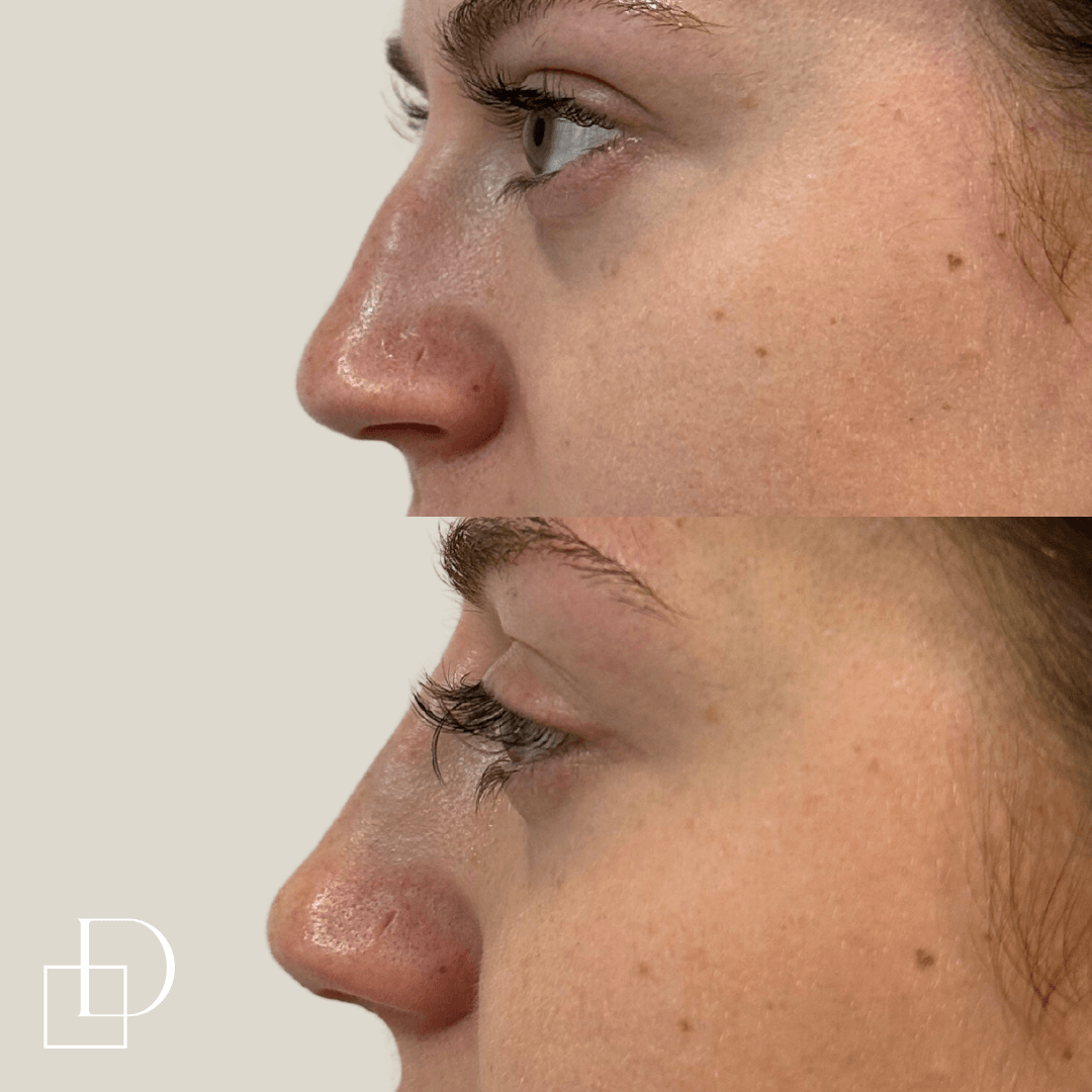 Before and after non-surgical rhinoplasty nose filler at Define Clinic Brisbane