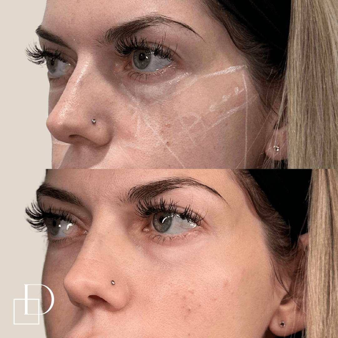 Before and after cheek filler injections at Define Clinic Brisbane