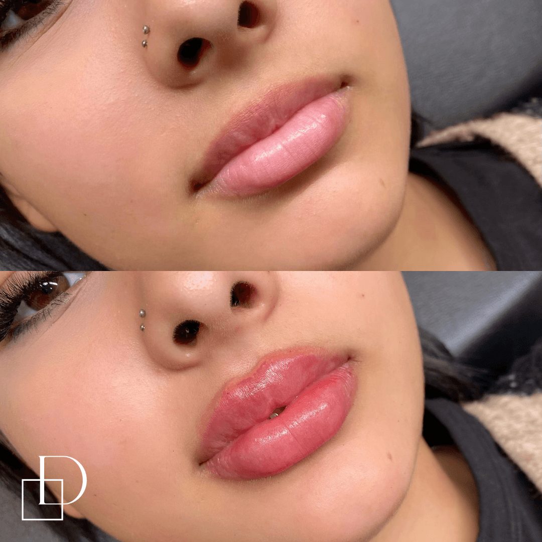 Before and after lip filler injections at Define Clinic Brisbane