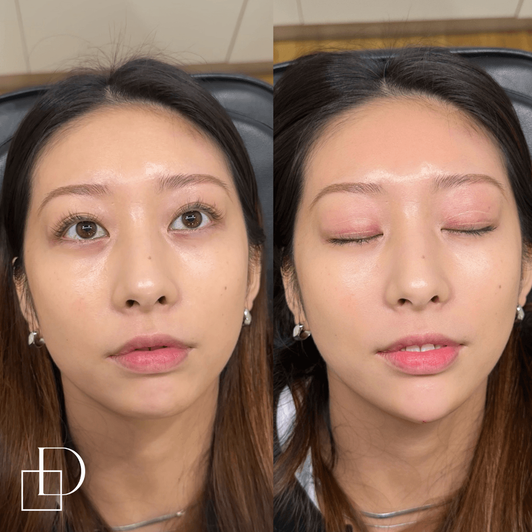 Before and after chin filler injections at Define Clinic Brisbane