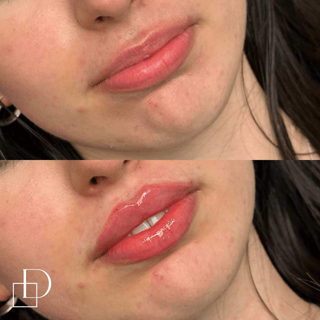 Before and after lip filler injections at Define Clinic Brisbane