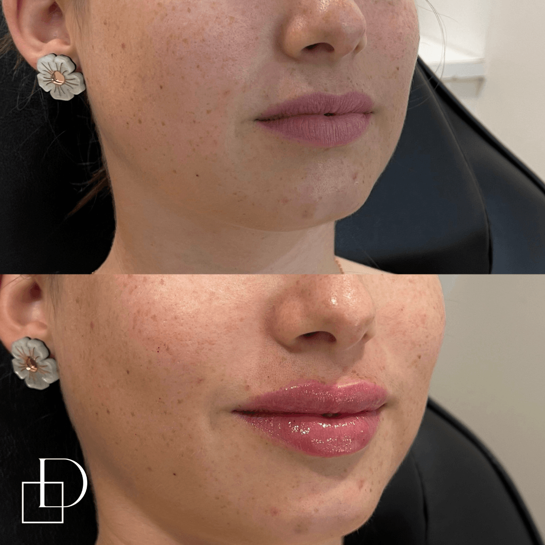 Before and after lip filler injections at Define Clinic Brisbane