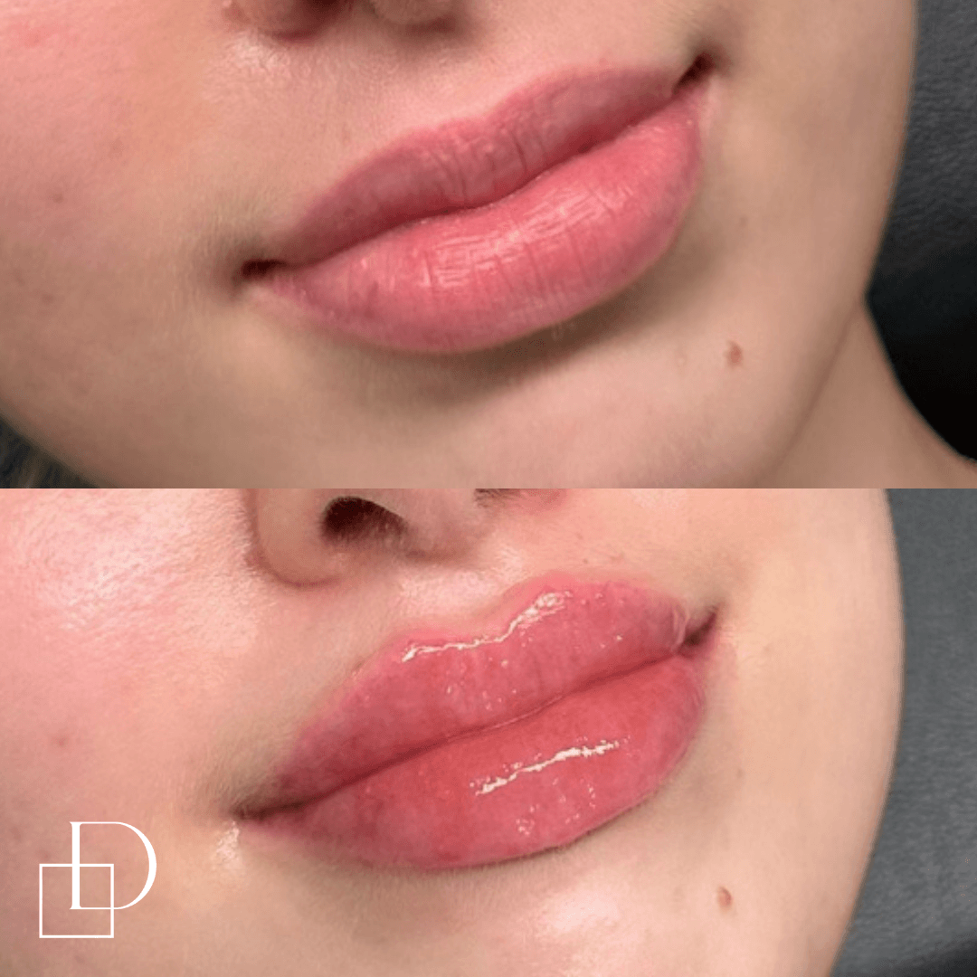 Before and after lip filler injections at Define Clinic Brisbane