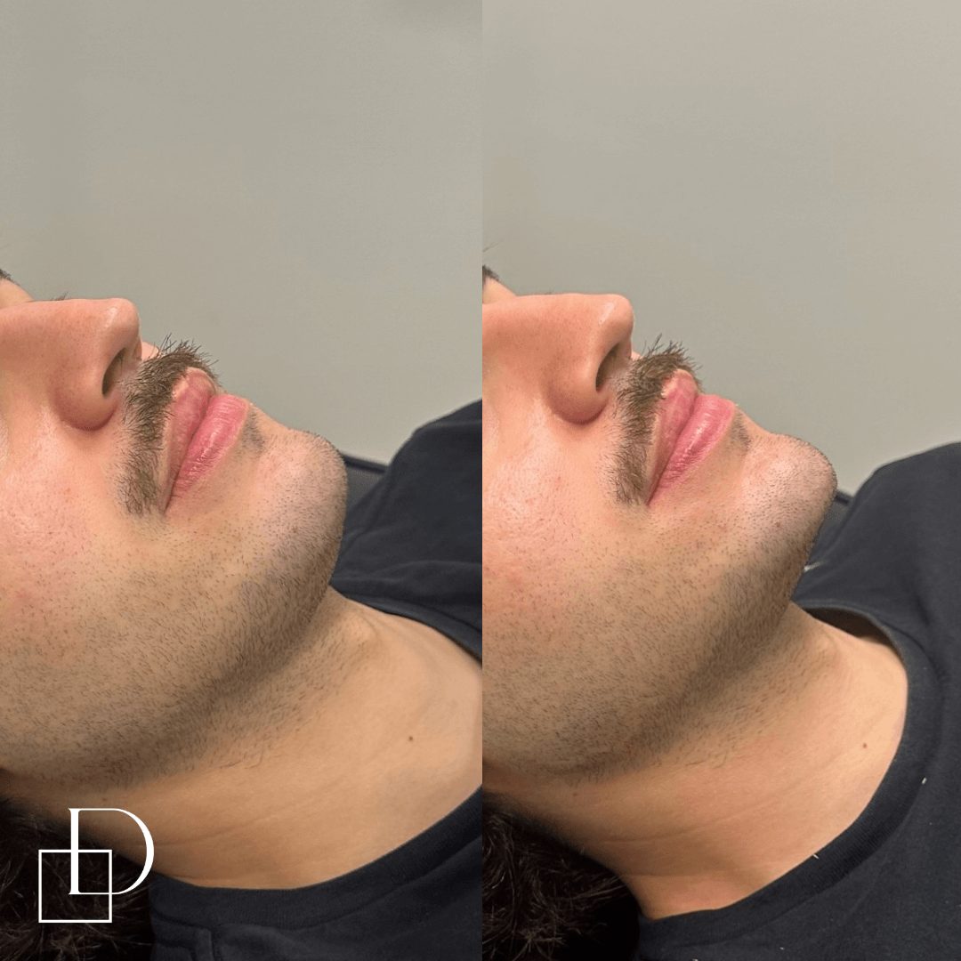 Before and after chin filler injections on male patient at Define Clinic Brisbane