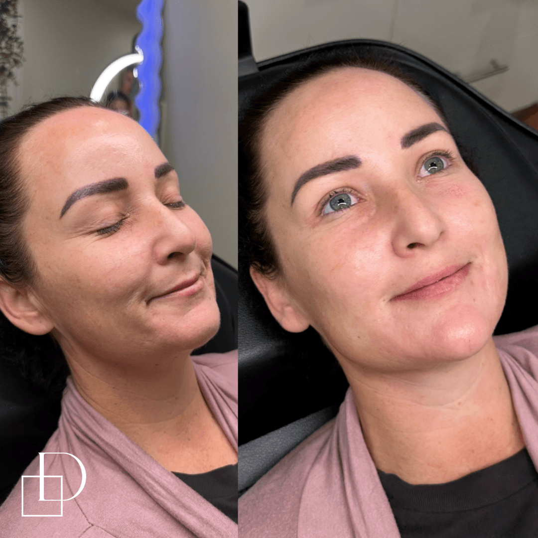 Before and after chin filler injections at Define Clinic Brisbane