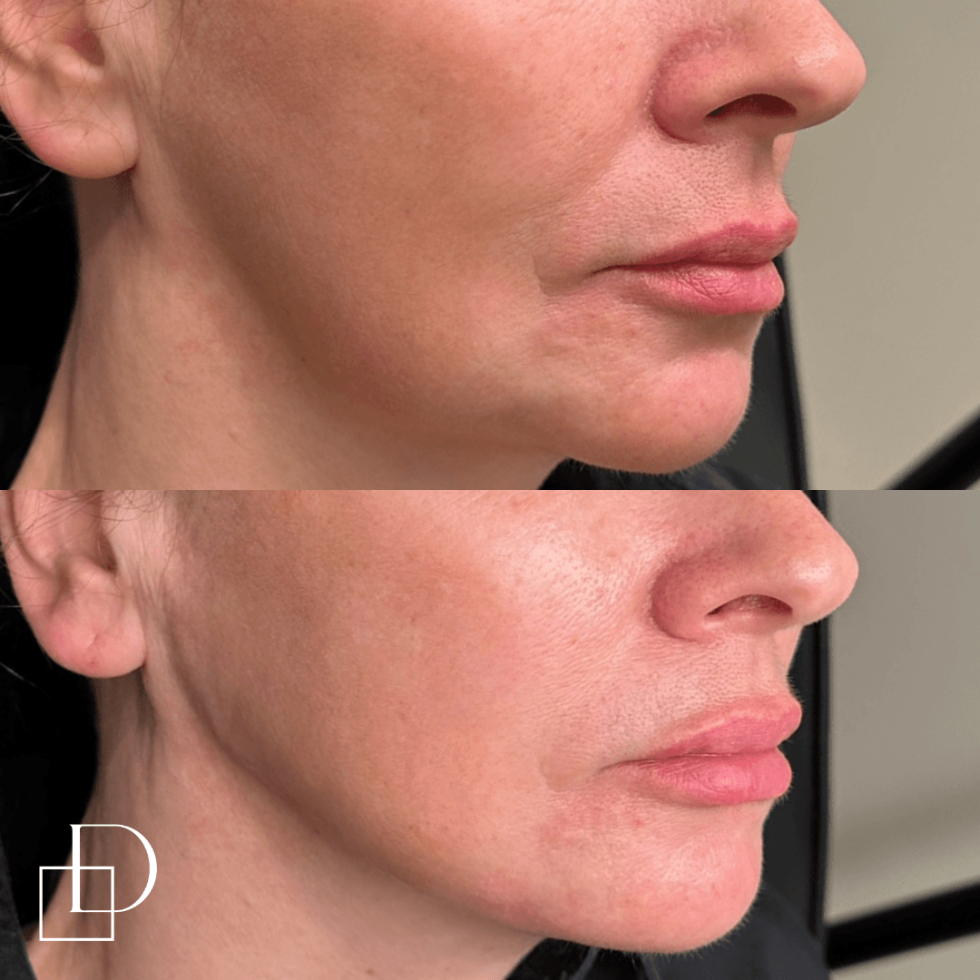 Before and after jawline filler injections at Define Clinic Brisbane