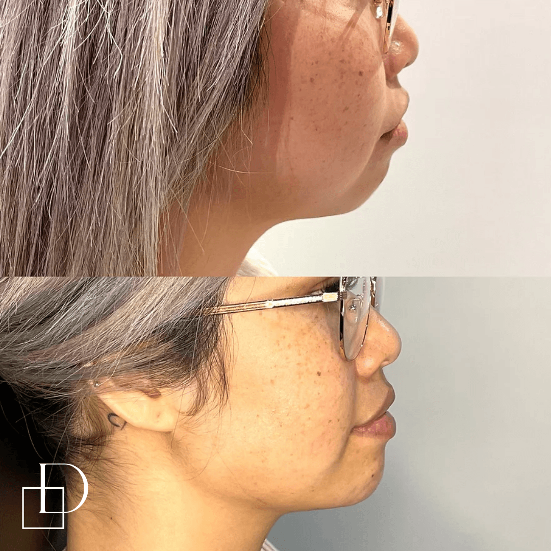 Before and after chin filler injections at Define Clinic Brisbane