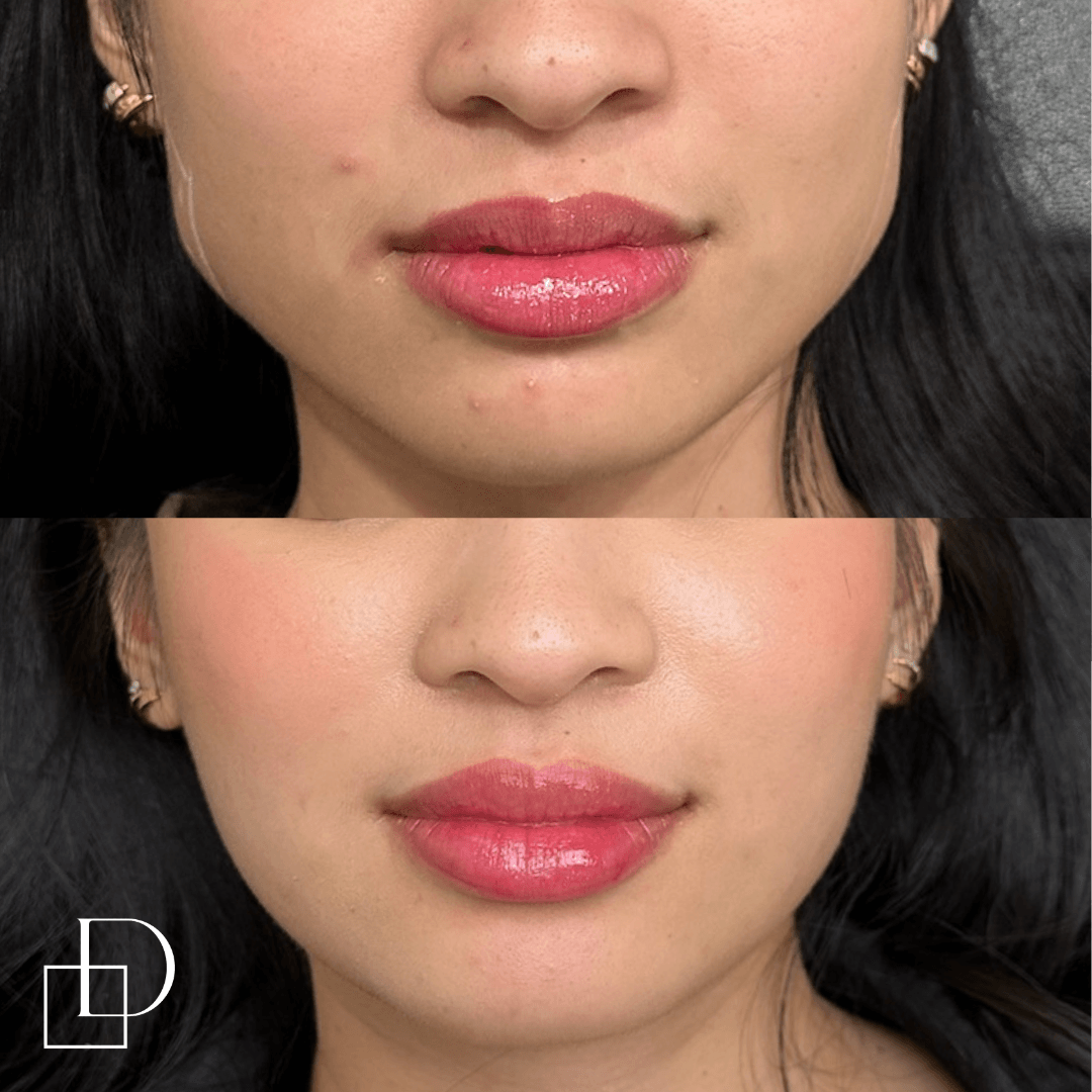 Before and after masseters botox at Define Clinic Brisbane