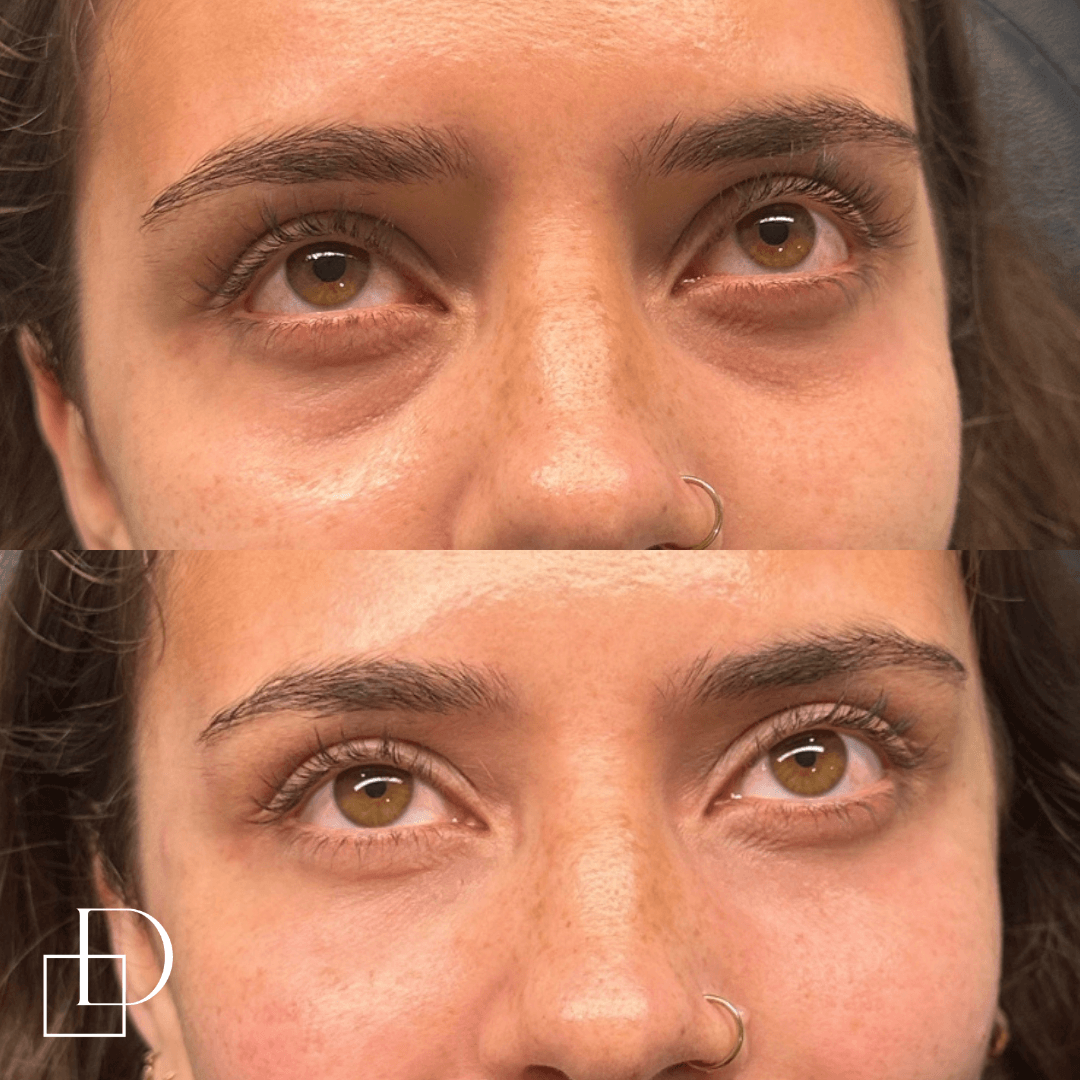 Before and after tear trough under eye filler injections at Define Clinic Brisbane