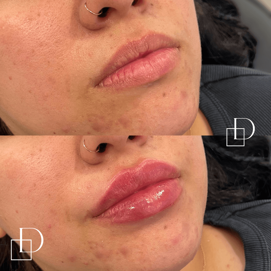 Before and after lip filler injections at Define Clinic Brisbane