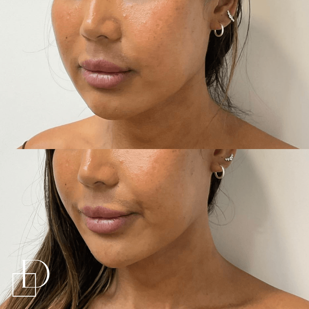 Before and after chin filler injections at Define Clinic Brisbane