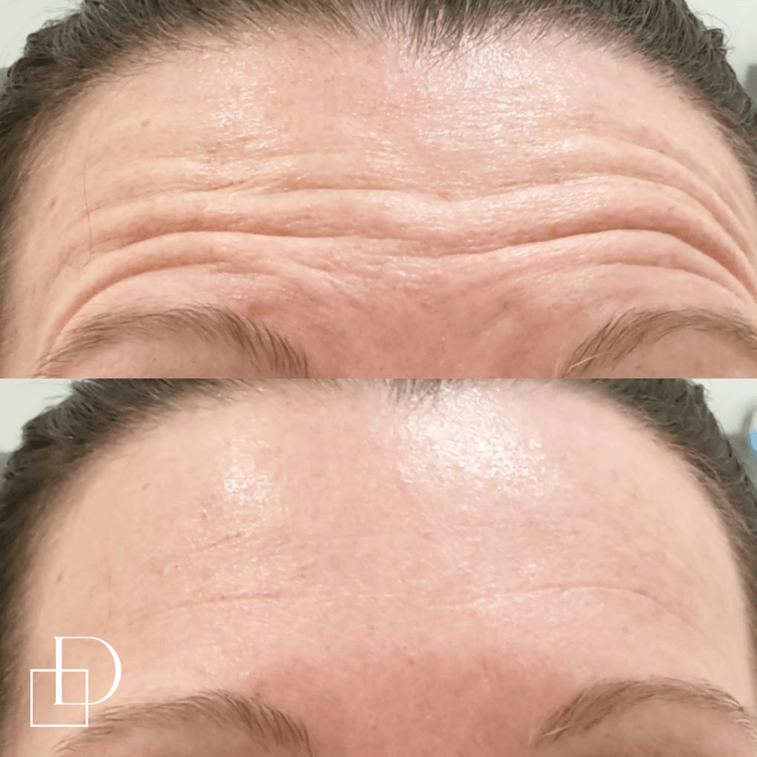 Before and after forehead botox anti-wrinkle at Define Clinic Brisbane