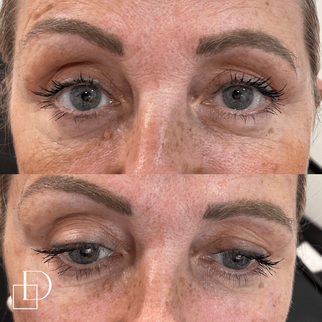 Before and after tear trough under eye filler injections at Define Clinic Brisbane