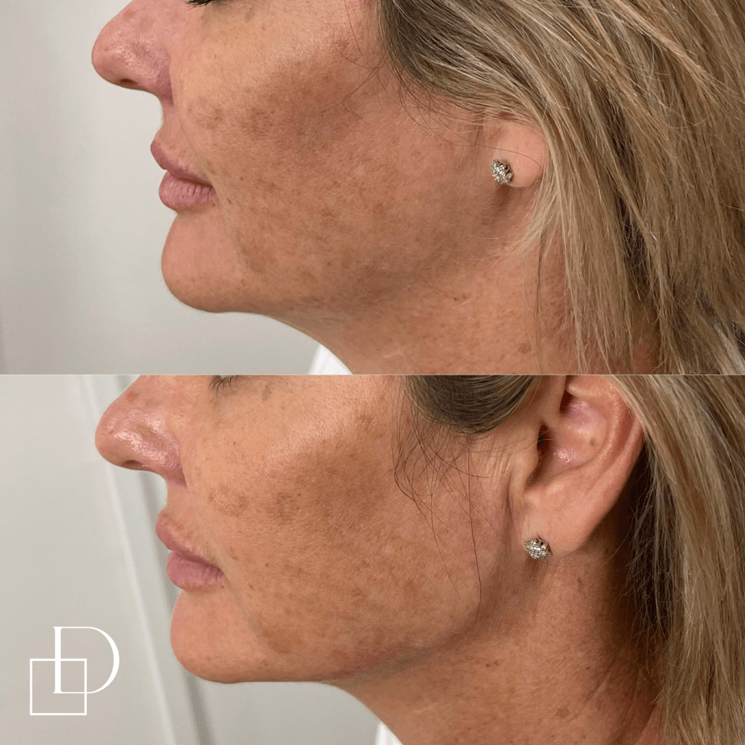 Before and after jawline filler injections at Define Clinic Brisbane