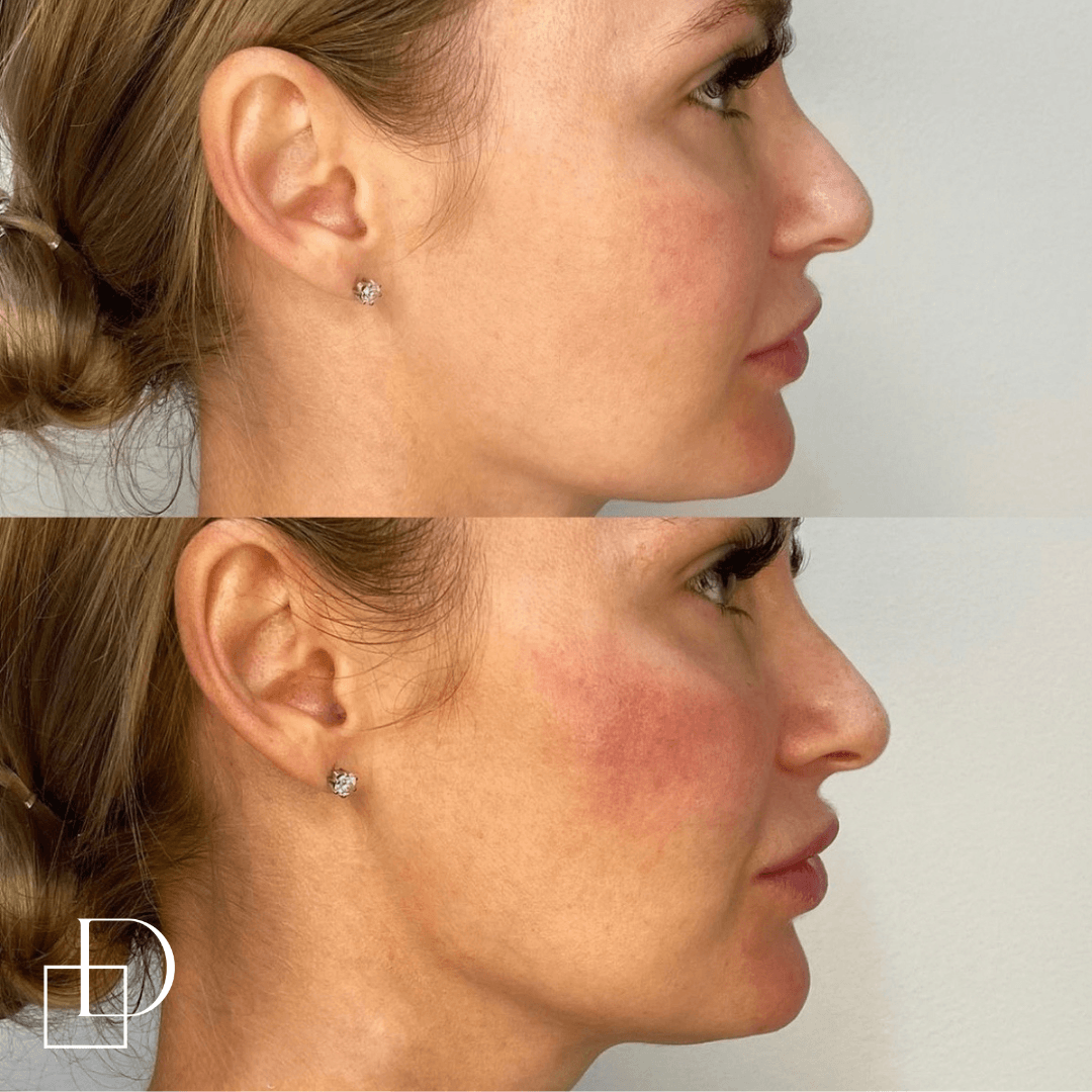 Before and after jawline filler injections at Define Clinic Brisbane