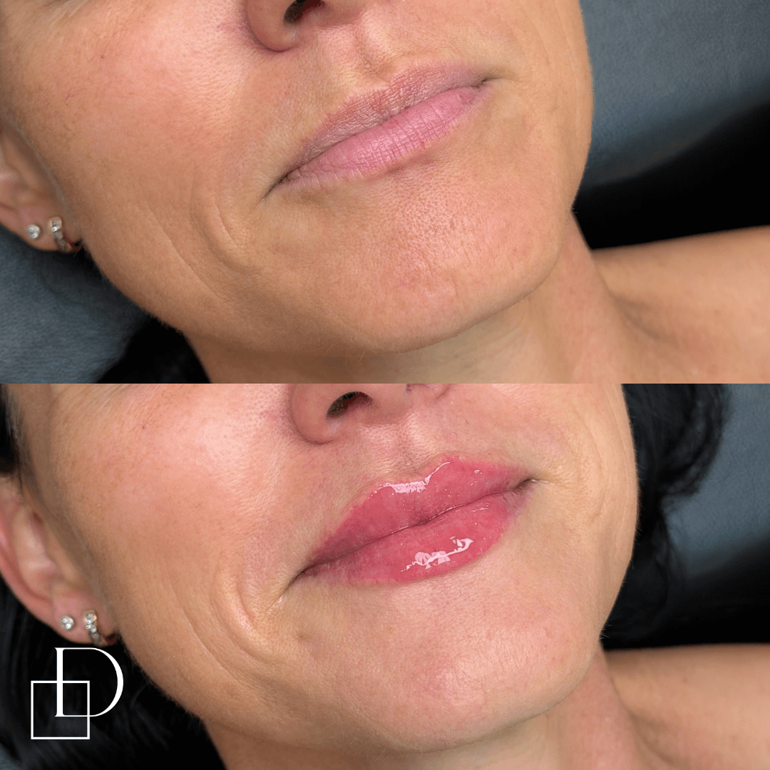 Before and after lip filler injections at Define Clinic Brisbane