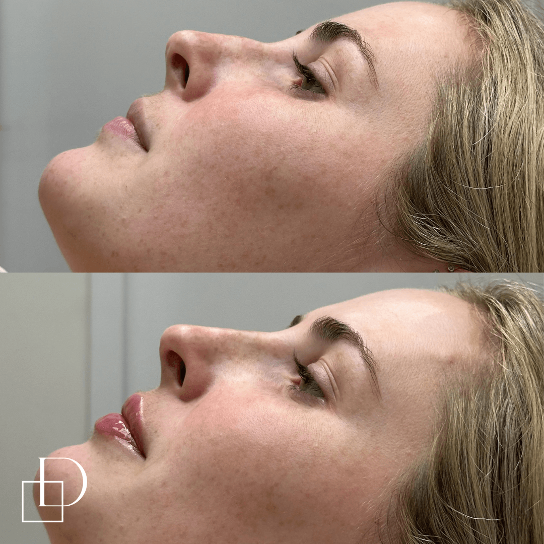 Before and after lip and nose filler injections at Define Clinic Brisbane