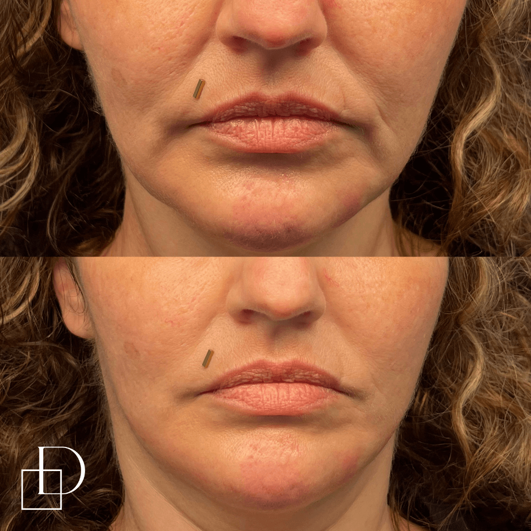 Before and after chin filler injections at Define Clinic Brisbane
