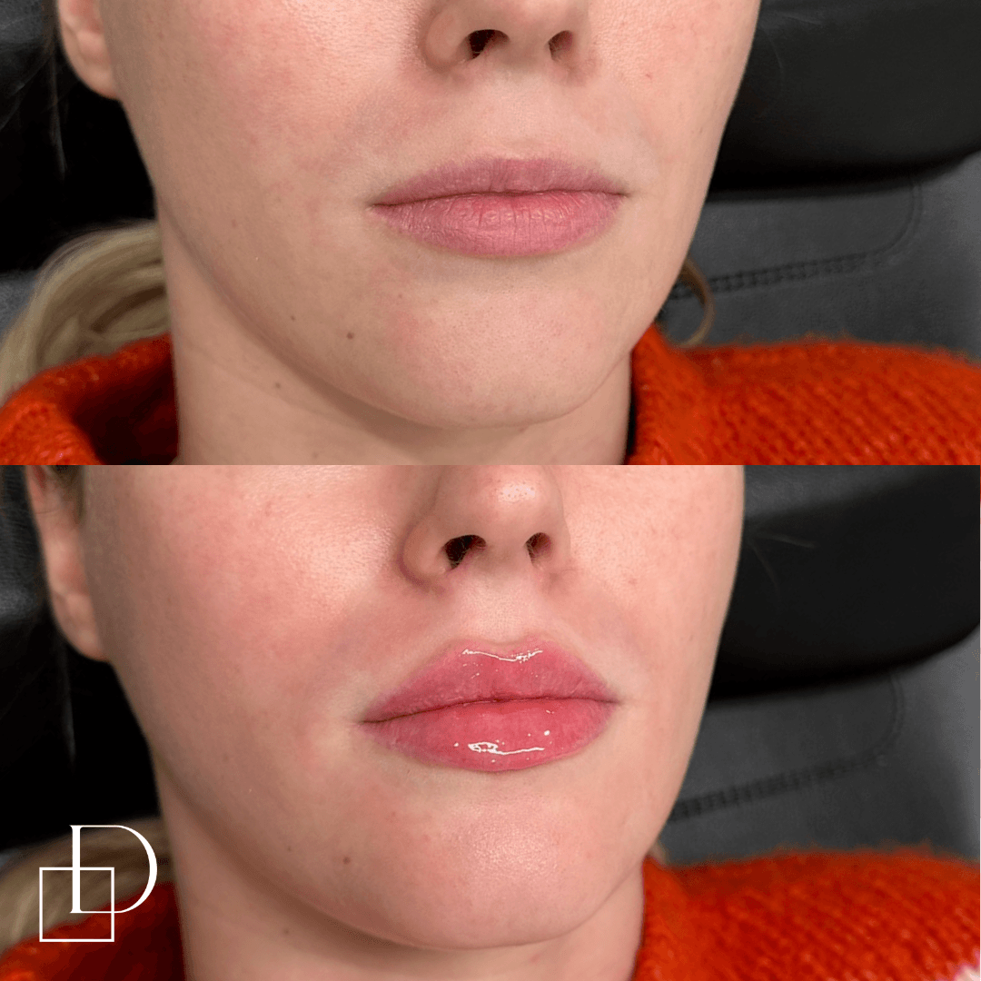 Before and after lip filler injections at Define Clinic Brisbane