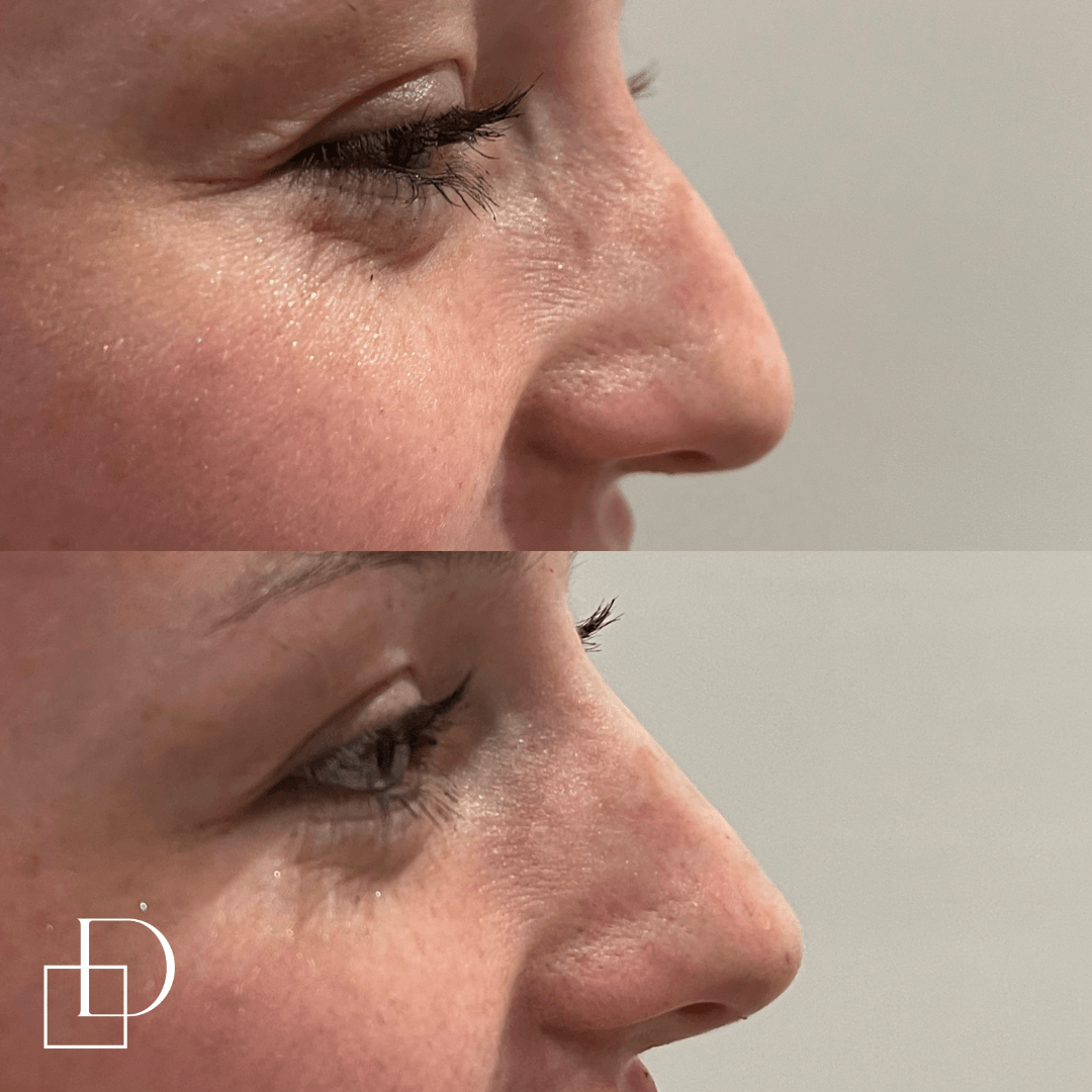 Before and after non-surgical rhinoplasty nose filler at Define Clinic Brisbane
