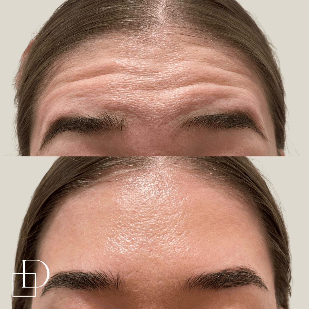 Before and after forehead botox anti-wrinkle at Define Clinic Brisbane