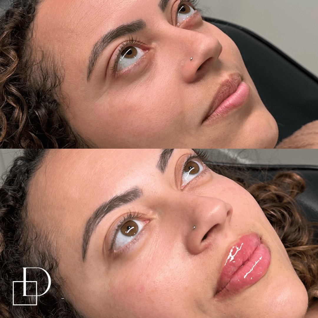 Before and after lip filler injections at Define Clinic Brisbane
