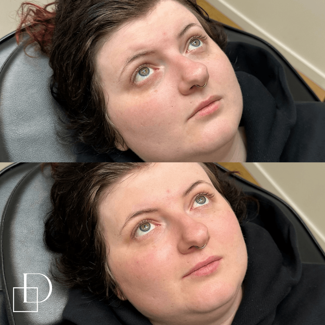 Before and after tear trough under eye filler injections at Define Clinic Brisbane