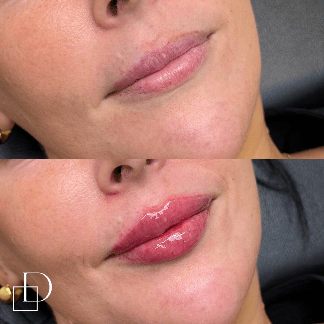 Before and after lip filler injections at Define Clinic Brisbane