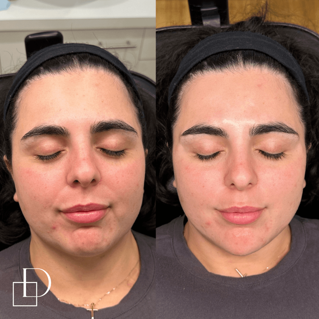 Before and after chin filler injections at Define Clinic Brisbane