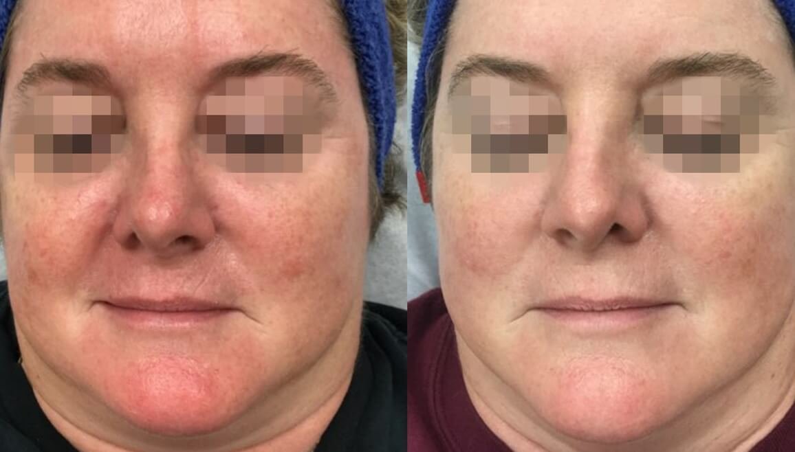Before and after redness treatment with Laser Genesis at Define Clinic Brisbane