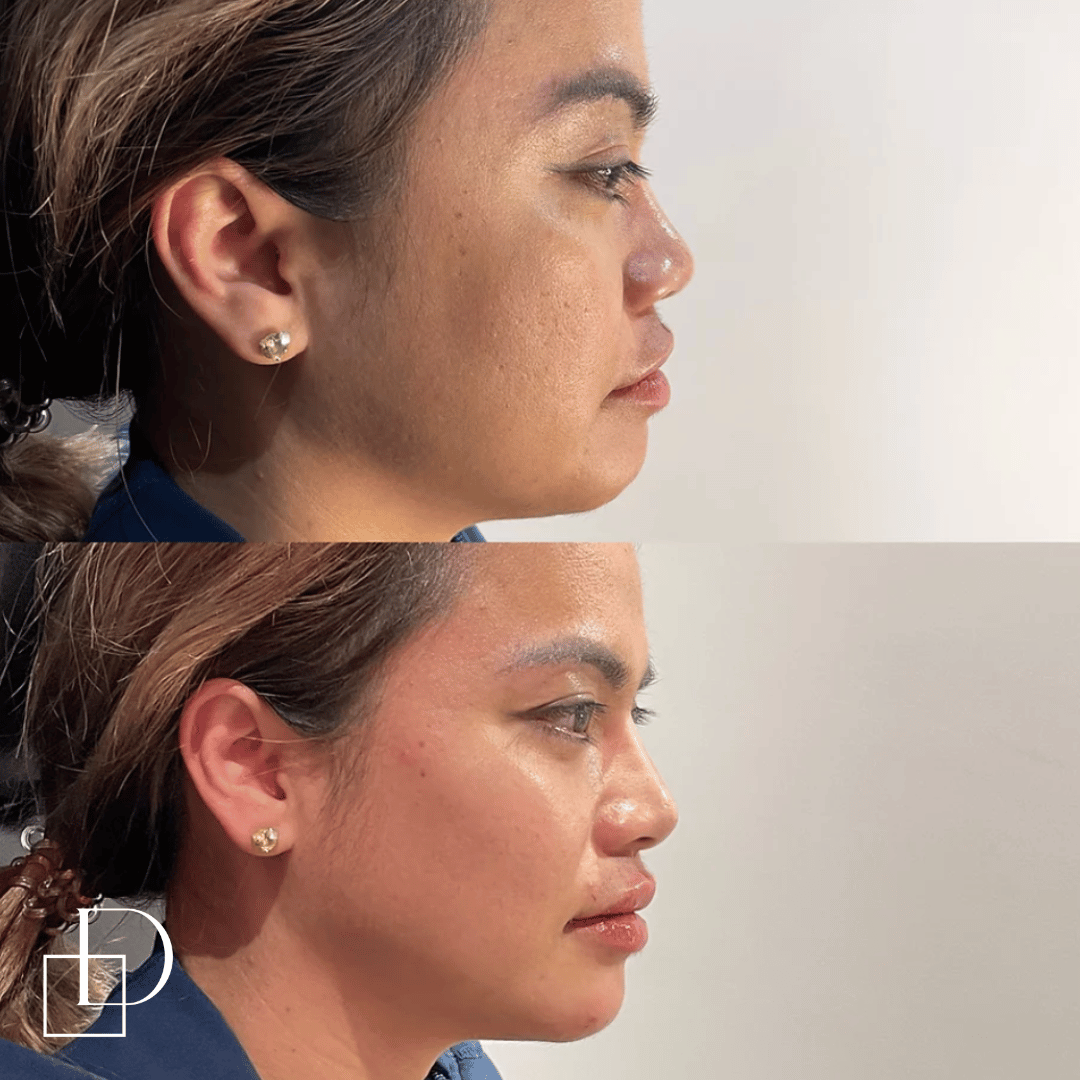 Before and after jawline filler injections at Define Clinic Brisbane