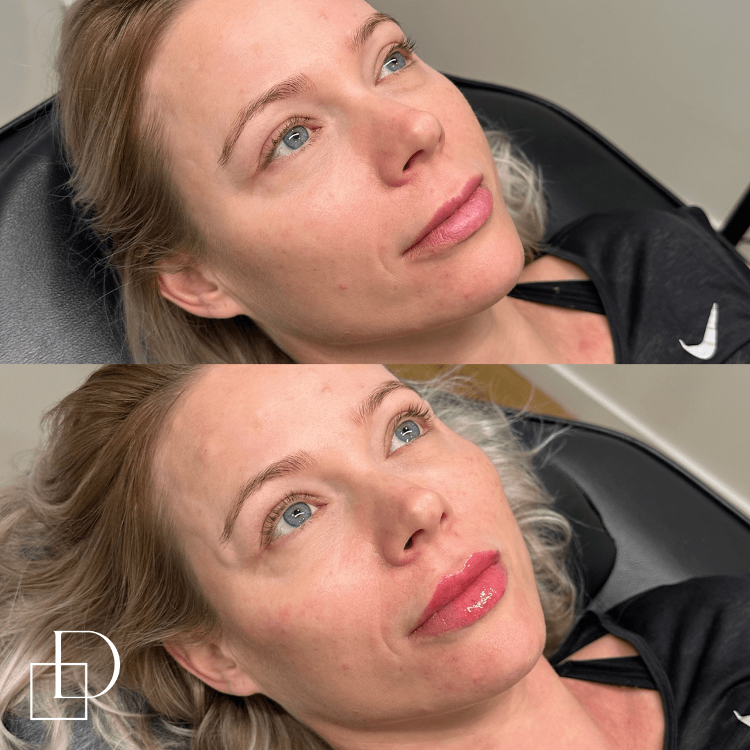 Before and after lip filler injections at Define Clinic Brisbane
