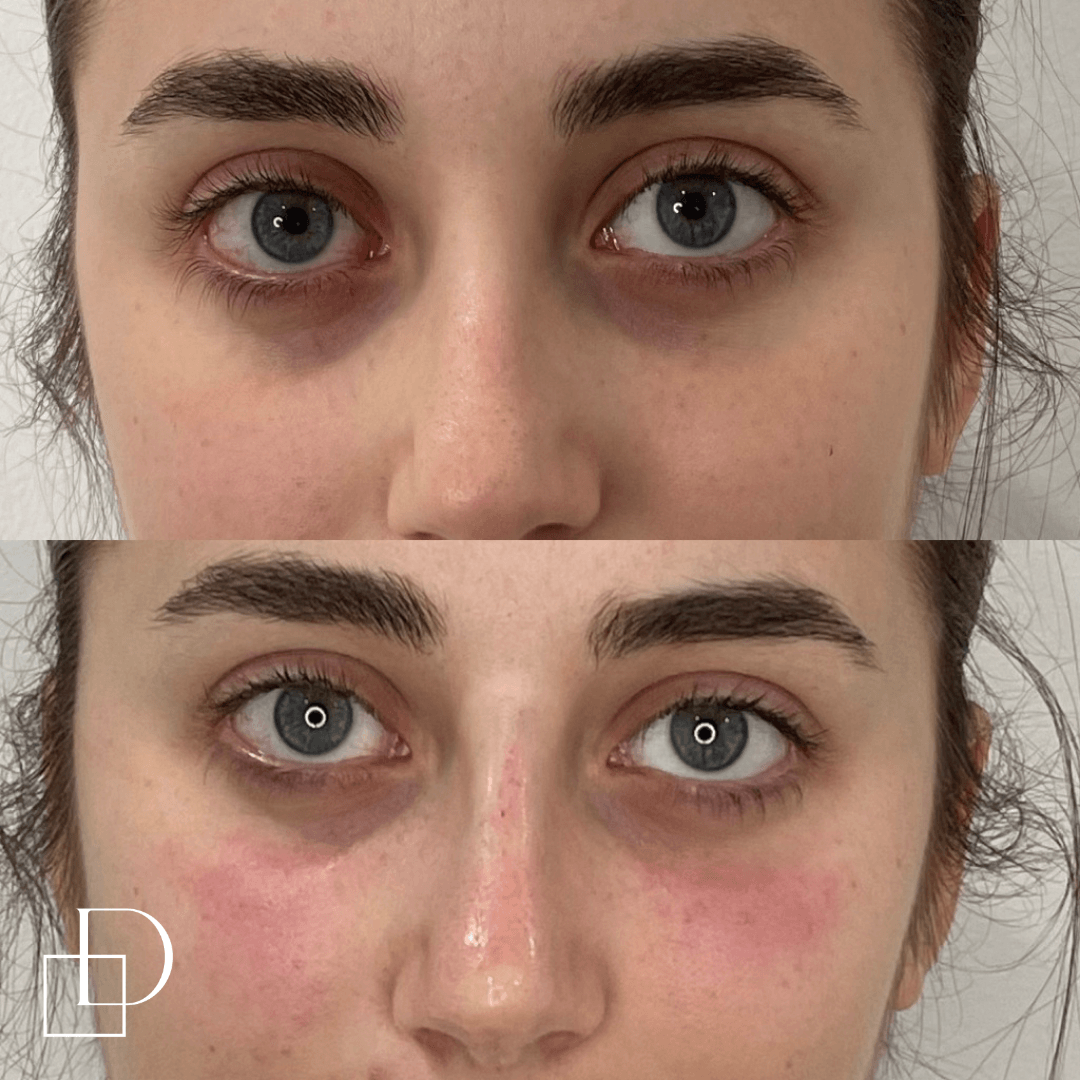 Before and after tear trough under eye filler injections at Define Clinic Brisbane