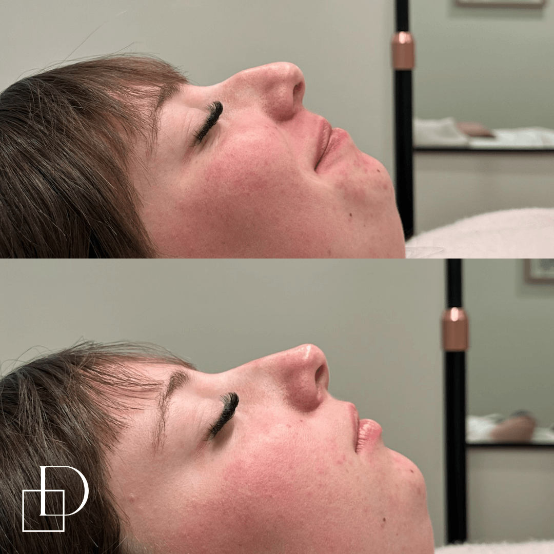Before and after non-surgical rhinoplasty nose filler at Define Clinic Brisbane