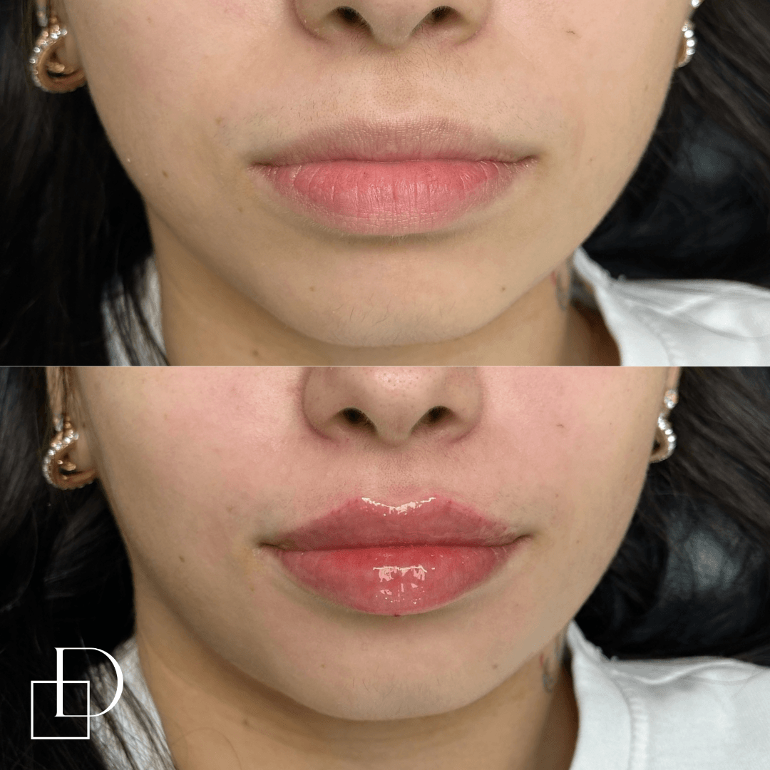 Before and after lip filler injections at Define Clinic Brisbane