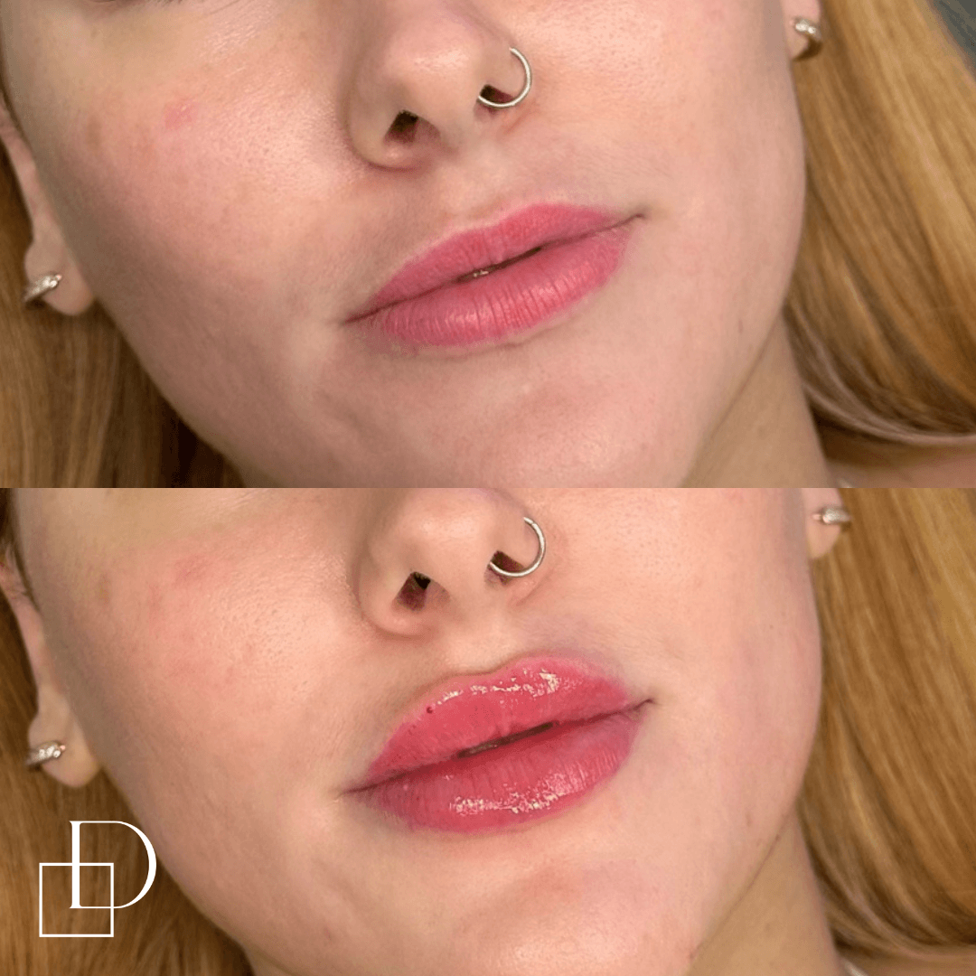 Before and after lip filler injections at Define Clinic Brisbane