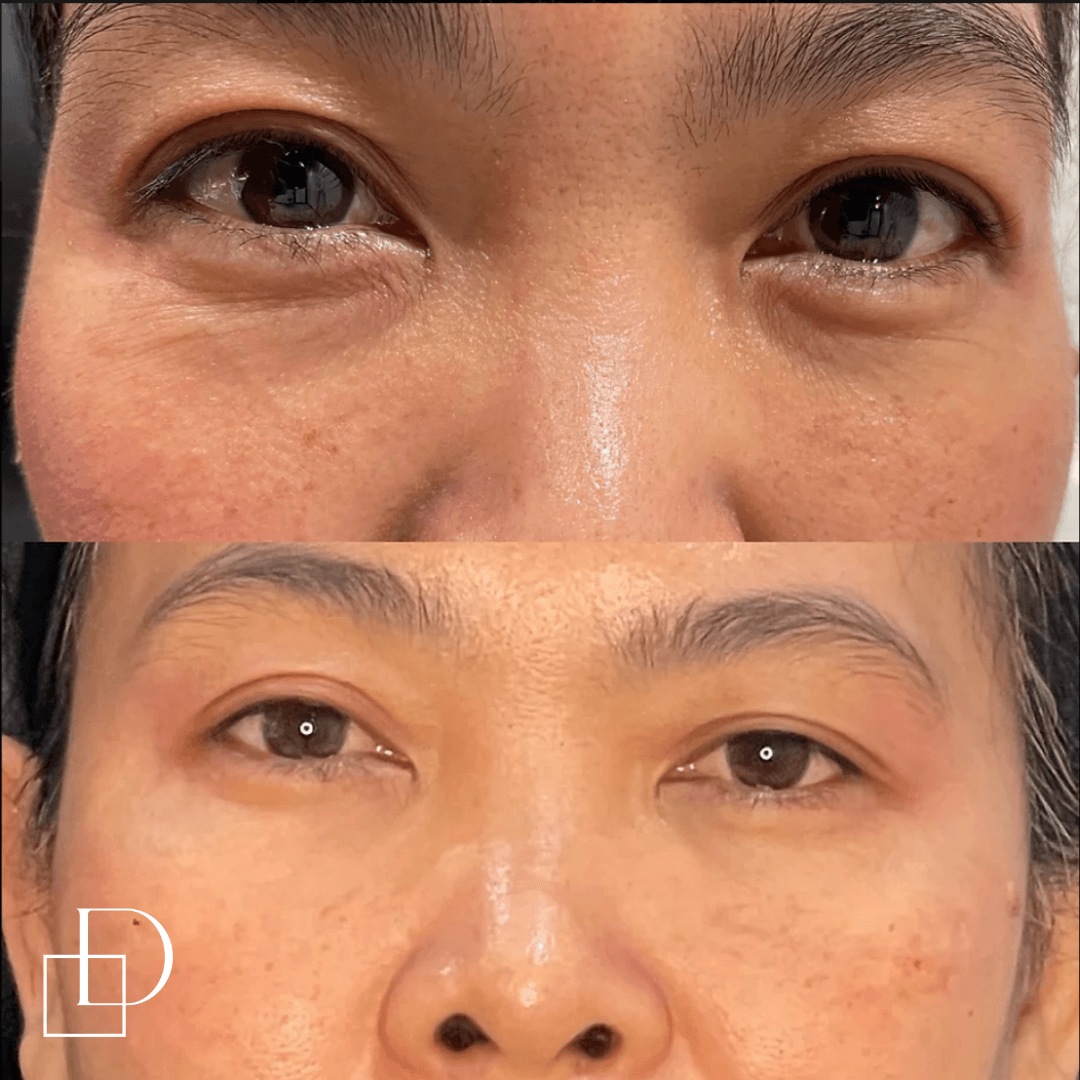 Before and after tear trough under eye filler injections at Define Clinic Brisbane